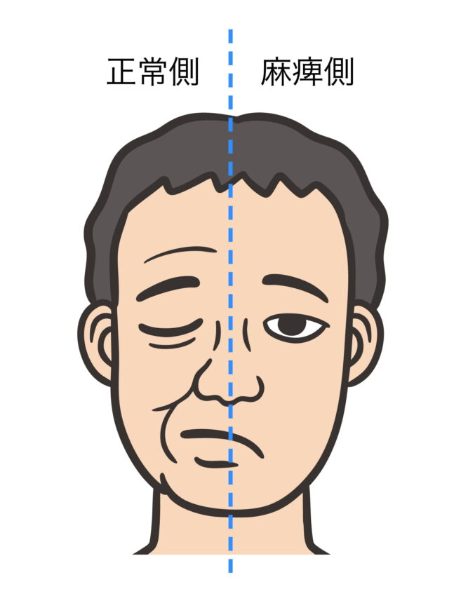顔面神経麻痺