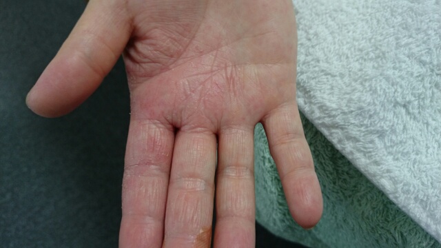 カンジタによる手湿疹の改善例